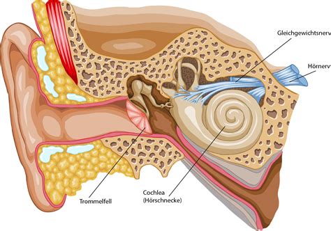 Cochlea Implantat Prothese Für Gehörlose Im Detail