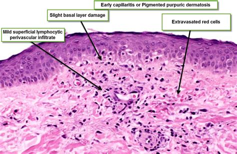 Dermatopathology Made Simple Inflammatory Superficial And Deep