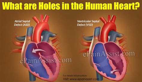 What Are Holes In The Human Heart