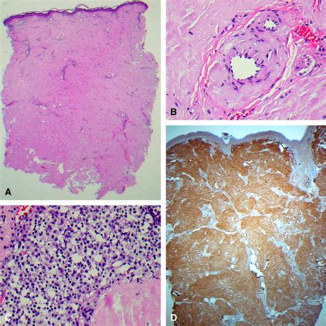Nodular Primary Localized Cutaneous Amyloidosis After Trauma A Case
