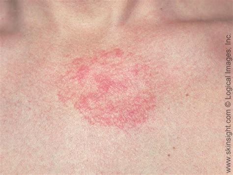 Dermatologists Advice On Managing Seborrheic Dermatitis Treatments Causes