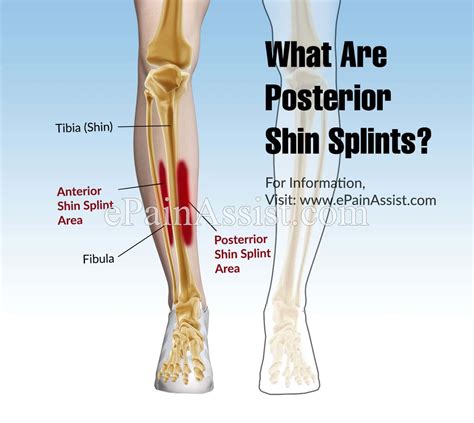 What Are Posterior Shin Splints