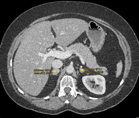 Bilateral Adrenal Pheochromocytomas Adrenal Case Studies Ctisus Ct