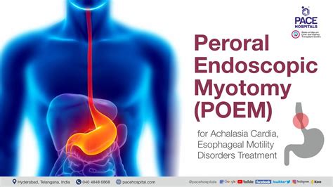 Poem Surgery Peroral Endoscopic Myotomy Poem Procedure For