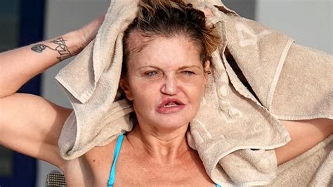danniella westbrook shows off results of facial surgery after frightening few days mirror online