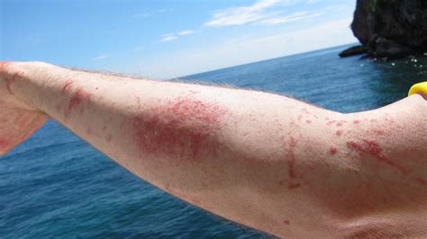 New Box Jellyfish Sting Spray Could Mean Fast Relief Hawaii Aloha Travel