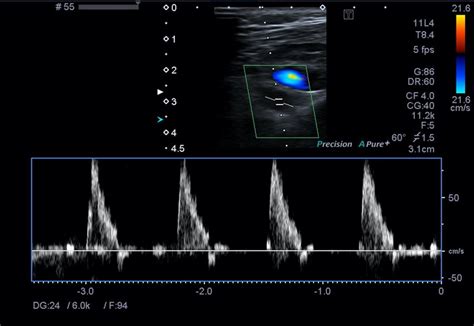 Normal Color Doppler Ultrasound Image Showing The Subclavian Artery