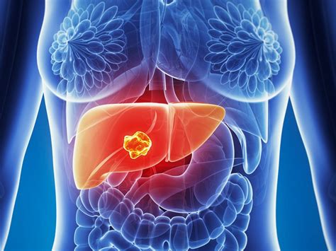 Screening At Risk Patients For Liver Cancer Uncertain