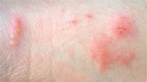 Pictures Of Common Skin Rashes Symptoms And Treatments Gohealth Urgent