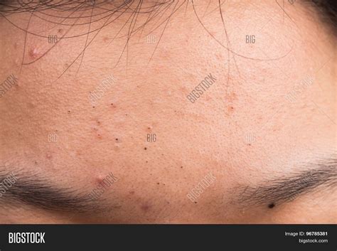 Closed On Pimple Image And Photo Free Trial Bigstock
