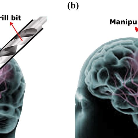 Schematic Of Brain Tumor And Single Port Minimal Invasive Surgical