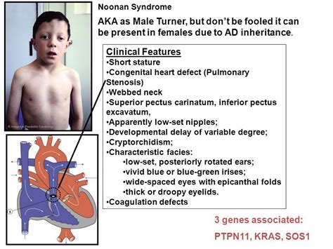 Pin By Nonas Arc On Noonan Syndrome Congenital Heart Defect Noonan
