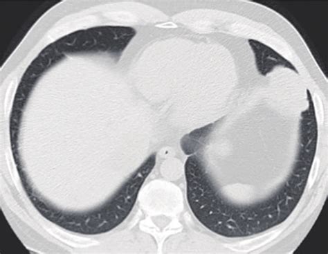 Lobulated 5 Cm Lung Mass In The Left Lingula Involving The Diaphragm