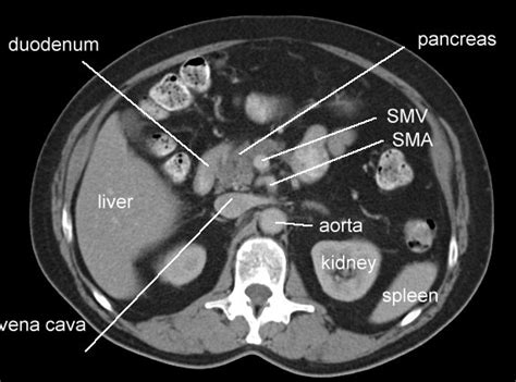 We did not find results for: Anatomy of the Pancreas