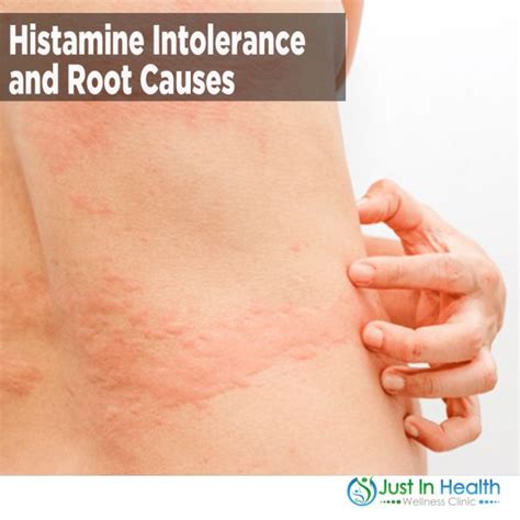 Histamine Intolerance And Root Causes Austin Texas Functional