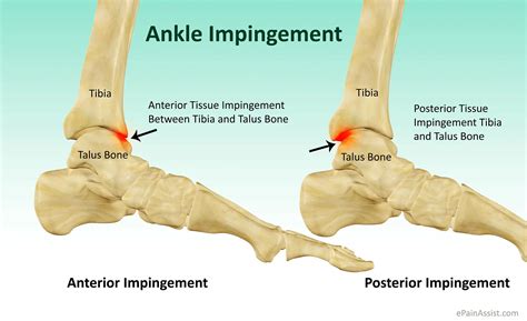 What Is Ankle Impingementsymptomscausestreatmentrecovery Period