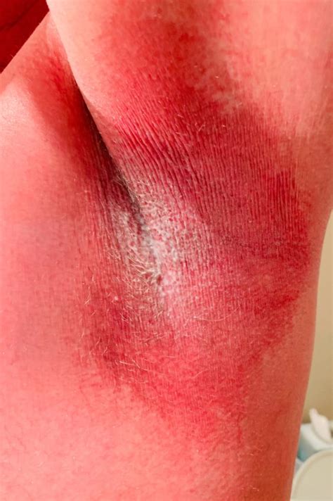 Case Study Painful And Itchy Rash On The Face Torso And Armpits