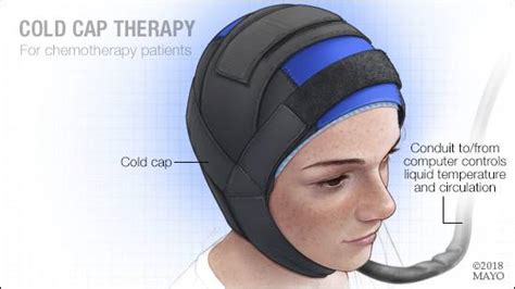 Mayo Clinic Q And A Cold Cap Therapy Can Reduce Hair Loss Caused By