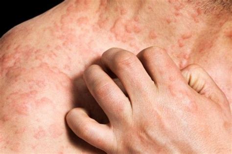 Severe Eczema Linked To Increased Risk For Heart Attack Stroke