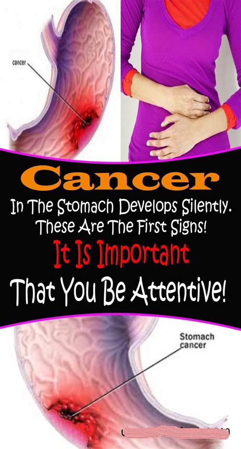 Cancer is always named based on the place where it starts. CANCER IN THE STOMACH DEVELOPS SILENTLY. THESE ARE THE ...
