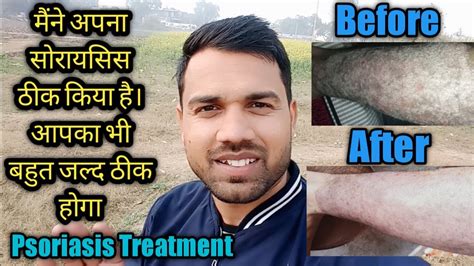 अब सोरायसिस होगा जड़ से खत्म Psoriasis Treatment In Hindi My Own