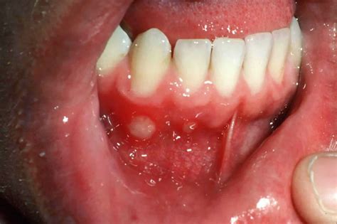 What Is Aphthous Stomatitis Dr Bratt