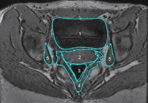 Manual Segmentation Results Of Ct Image Bladder Vagina Rectum