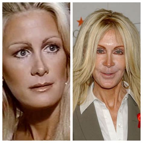 Joan Van Ark What Happened Before And After Plastic Surgery Plastic Surgery Gone Wrong