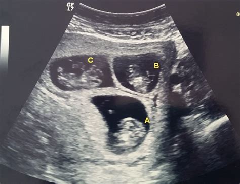 Triplets Ultrasound  Artofit