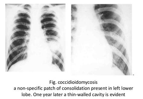 Imaging In Fungal Infection Of Chest