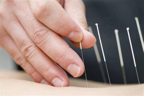 Dry Needling Trademark Therapy Myotherapy Sports Therapy Massage Docklands Cbd Richmond