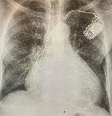 Pacemaker Lead Induced Tricuspid Regurgitation And Imaging