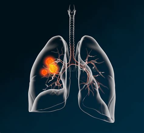 Lungenkrebs Stock Abbildung Illustration Von Bronchiolar 5564055