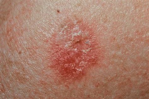 Skin Cancer Pictures Most Common Skin Cancer Types With Images Reverasite