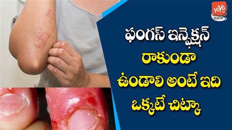 Fungal Infection Tips Advanced Fungal Infection Treatment Telugu