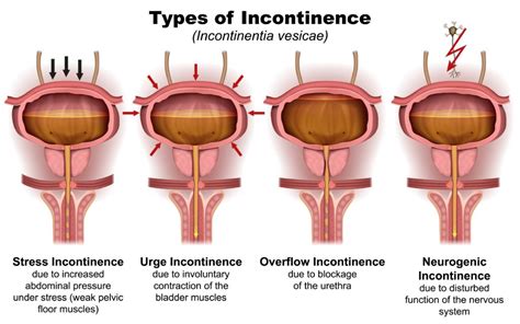 Causes Types Of Stress Urinary Incontinence Chicago Urogynecology