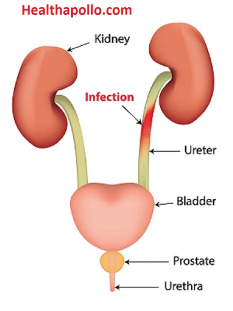 Uti Urinary Tract Infection Causes Symptoms And Home Remedies