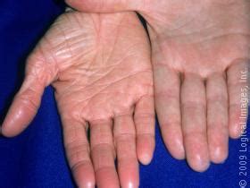 Ichthyosis Vulgaris Treatment Dorothee Padraig South West Skin Health
