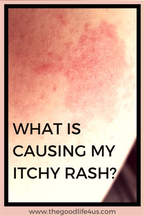 Identify Different Types Of Skin Rashes And Causes Skin Cares