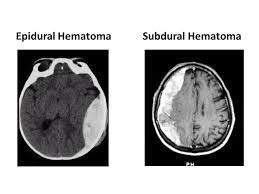 Subdural haemorrhage the meninges are the connective tissue membranes that line the skull and the epidural space is the space between the vertebral column and the dura mater. head injury Archives - MD direct