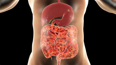 Irritable Bowel Syndrome Ibs Signs Causes And Treatments The Healthy