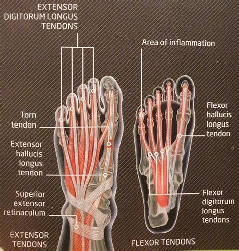 Tendon Injuries In Foot And Ankle Massage Kildare Naas Portlaoise