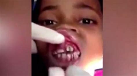 Video Shows 15 Maggots Being Removed From Schoolgirls Gums The