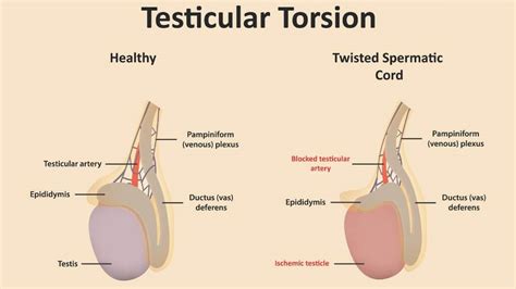 Testicular Torsion Causes Symptoms And Long Term Outlook 1md Nutrition™