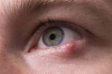Bumps On Eyeball Causes Types And Treatment