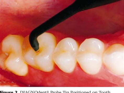 Figure 2 From Oral Health Screening Using A Caries Detection Device