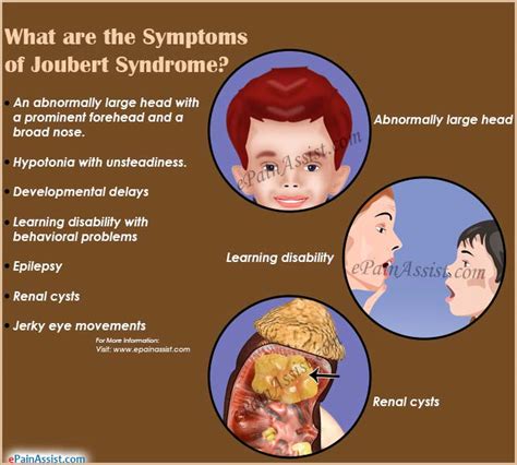 Joubert Syndromecausessymptomstreatmentprognosis