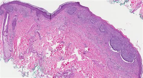 Carcinoma Basocelular Superficial MyPathologyReport Ca