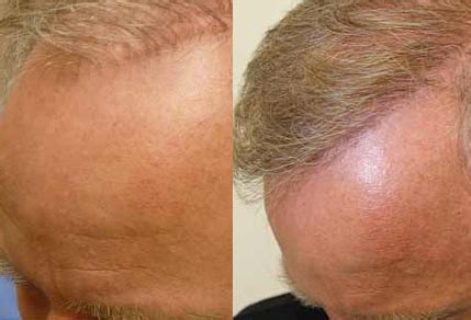 Before And After Revision Hair Transplant 50 Years Old Male 3200