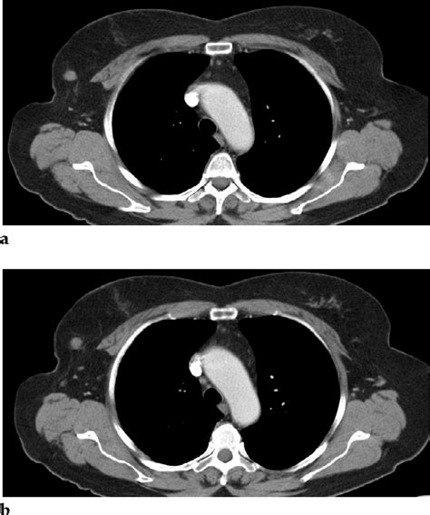 Figure 2 From A Rare Case Of Primary Breast Mucosa Associated Lymphoid